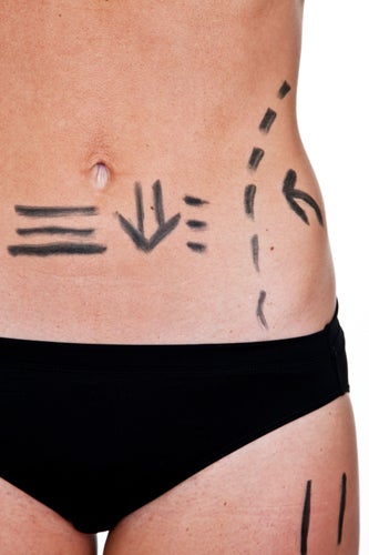 Cellulite-treatment-liposuction